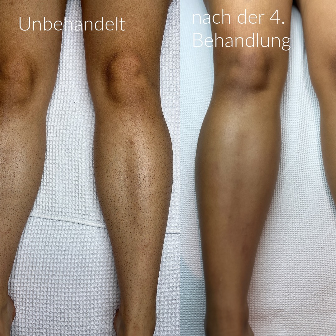 Vorher/Nachher Beine Behandlung